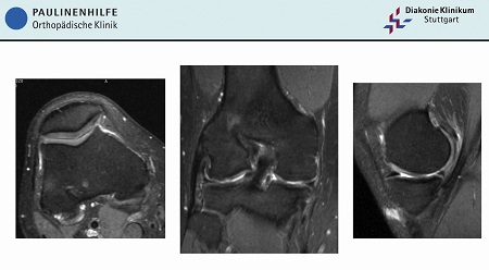 AGAnywhere Monthly - #002: Kniearthrose beim jüngeren Patienten – thumbnail 2 of 15
