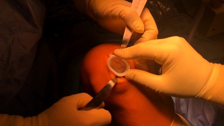 #195: Operationstechnik des Episealers bei (osteo-)chondralen Schäden am Kniegelenk (Part 2) – thumbnail 2 of 5