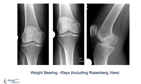 #195: Operationstechnik des Episealers bei (osteo-)chondralen Schäden am Kniegelenk (Part 2) – thumbnail 3 of 5