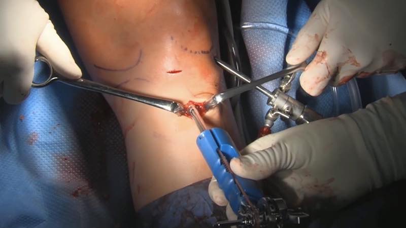 #257: Insights from the OR - Kreuzbandruptur – thumbnail 3 of 8