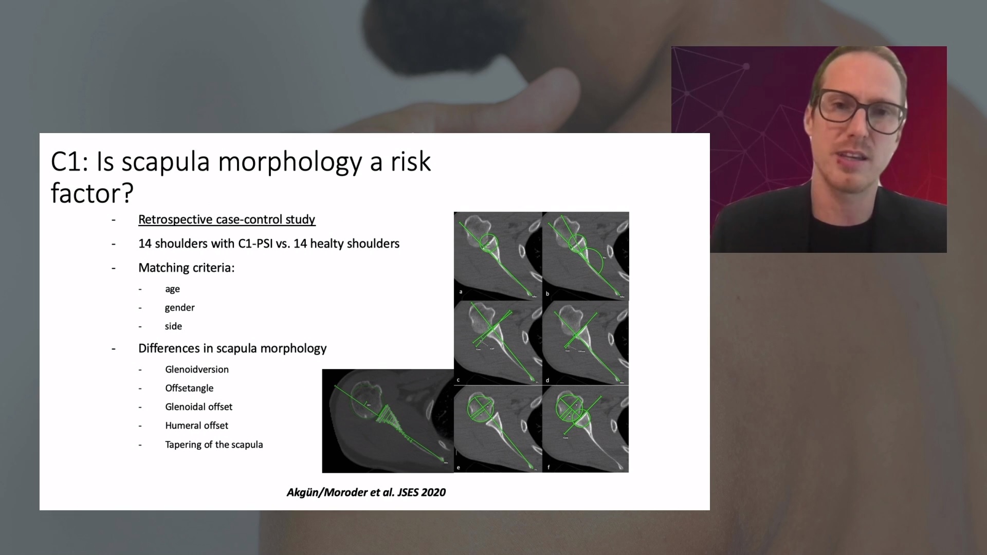 #1811: Static Posterior Glenohumeral Subluxation without Arthritis – thumbnail 3 of 6
