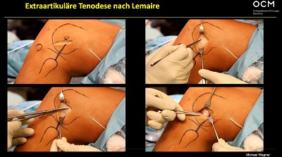 AGAnywhere Monthly - #005: Periphere Instabilitäten des Kniegelenkes – thumbnail 4 of 12
