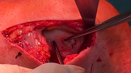 #214: Minced Cartilage mit Chondro-Gide – thumbnail 4 of 8