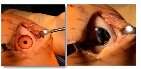 #195: Operationstechnik des Episealers bei (osteo-)chondralen Schäden am Kniegelenk (Part 2) – thumbnail 4 of 5