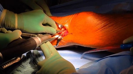 #255: Basics in Osteotomy around the Knee – thumbnail 4 of 10