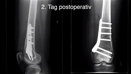 #255: Basics in Osteotomy around the Knee – thumbnail 5 of 10