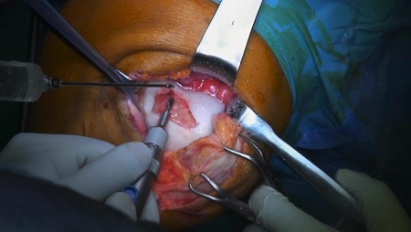 #214: Minced Cartilage mit Chondro-Gide – thumbnail 6 of 8