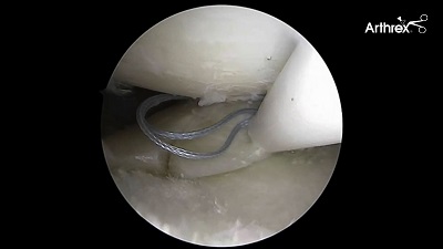 Meniscus Preservation in Degenerative Disorders – thumbnail 6 of 16