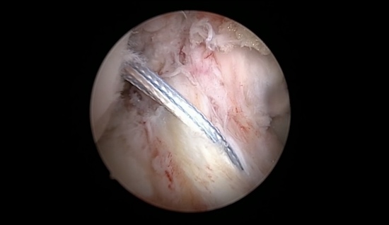 #257: Insights from the OR - Kreuzbandruptur – thumbnail 6 of 8