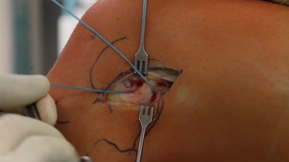 #257: Insights from the OR - Kreuzbandruptur – thumbnail 7 of 8