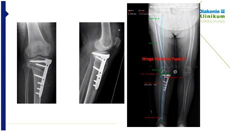 #255: Basics in Osteotomy around the Knee – thumbnail 8 of 10