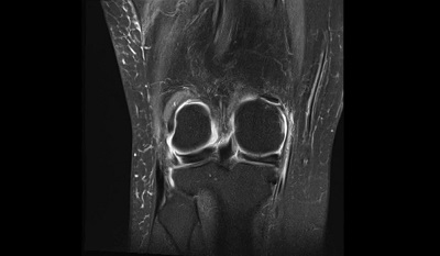 Meniscus Preservation in Degenerative Disorders – thumbnail 9 of 16