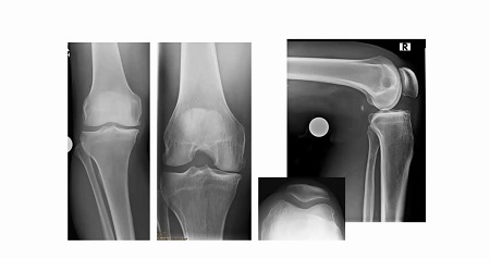 AGAnywhere Monthly - #002: Kniearthrose beim jüngeren Patienten – thumbnail 9 of 15