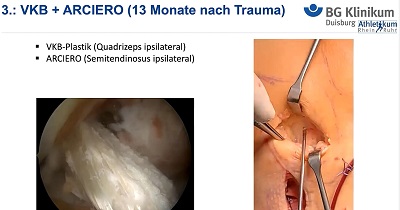 AGAnywhere Monthly - #005: Periphere Instabilitäten des Kniegelenkes – thumbnail 9 of 12