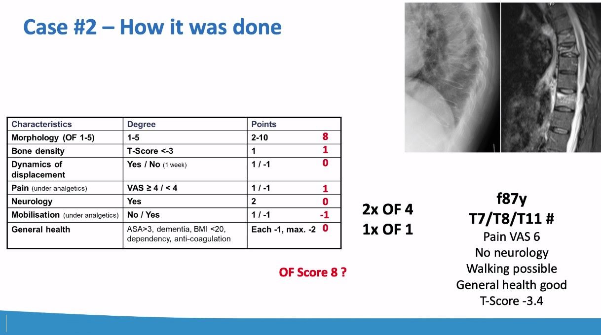 Winglet Originals #020: Minimally-Invasive Fixation of Thoracolumbar Osteoporotic Vertebral Compression Fractures – thumbnail 10 of 13
