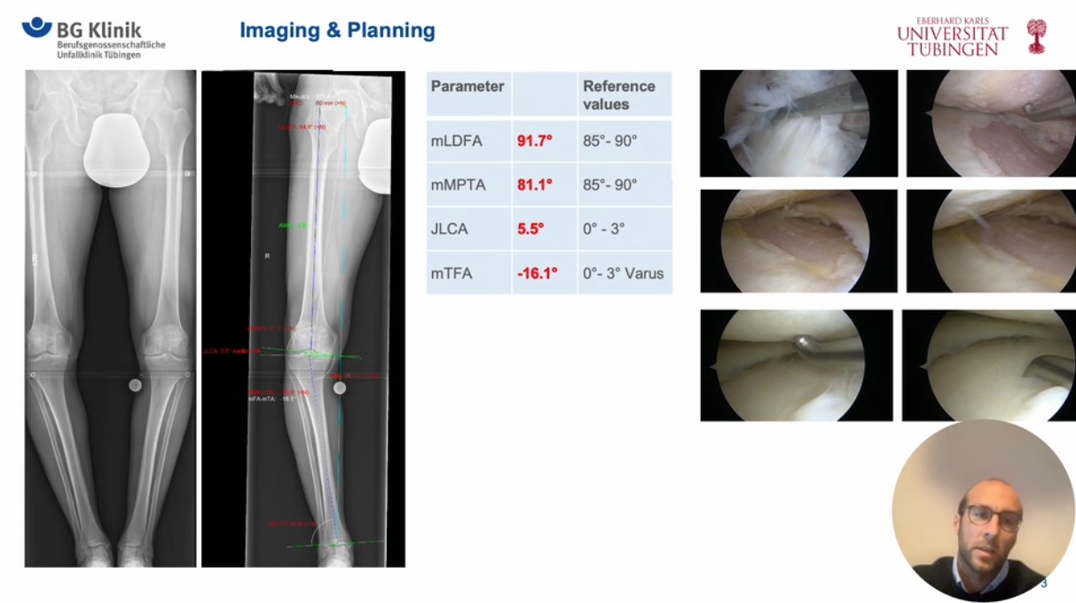 Winglet Originals #022: Osteotomies Around the Knee - Deformity Analysis and its Relevance for Surgical Correction – thumbnail 10 of 12