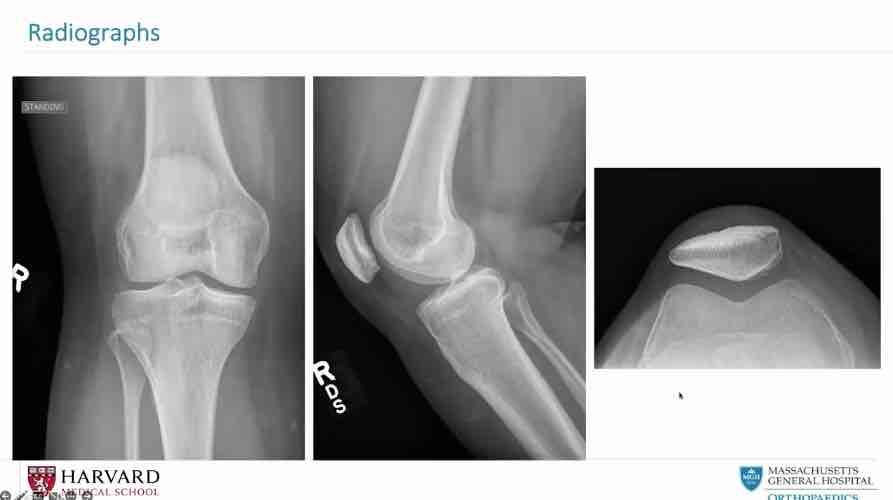 Winglet Originals #008: Patellofemoral Pain – thumbnail 10 of 12