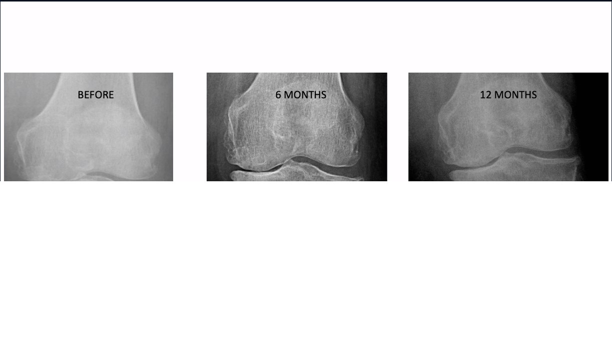 ICRS TV Series - #005: Biologic Knee Replacement: Basic Science of Aging of Cartilage – thumbnail 9 of 12