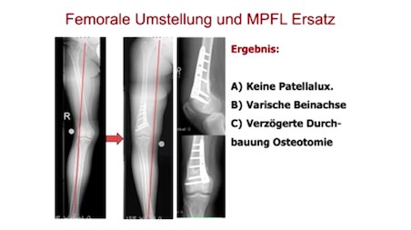 AGAnywhere Monthly - #010: Behandlung von chondralen und osteochondralen Defekten am Kniegelenk – thumbnail 10 of 12