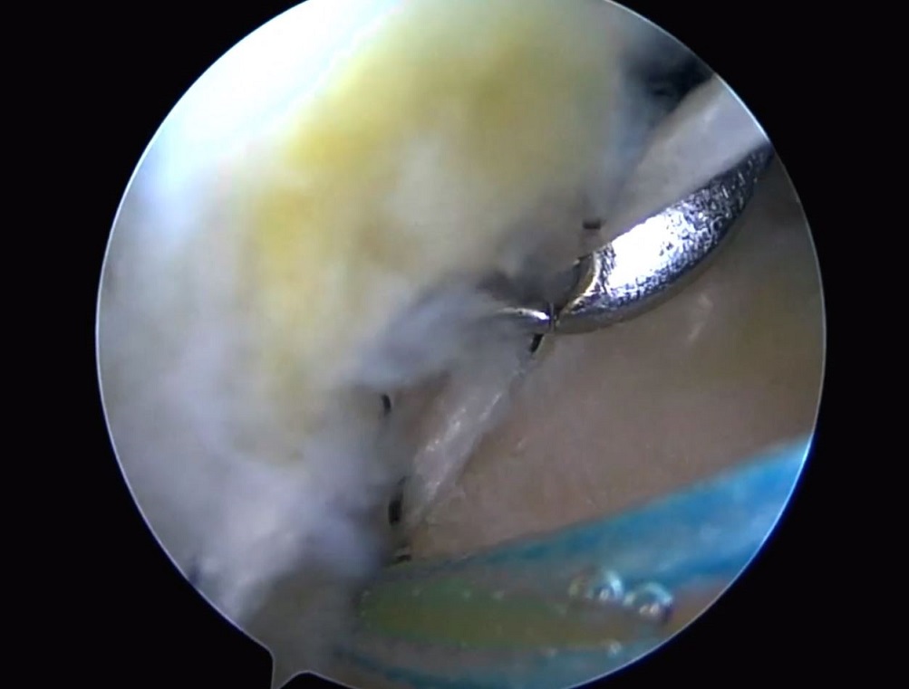 #2611: Update Rotatorenmanschette – thumbnail 10 of 12