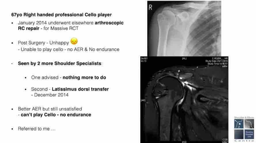 Winglet Originals #009: Massive Tears of the Rotator Cuff – thumbnail 10 of 12