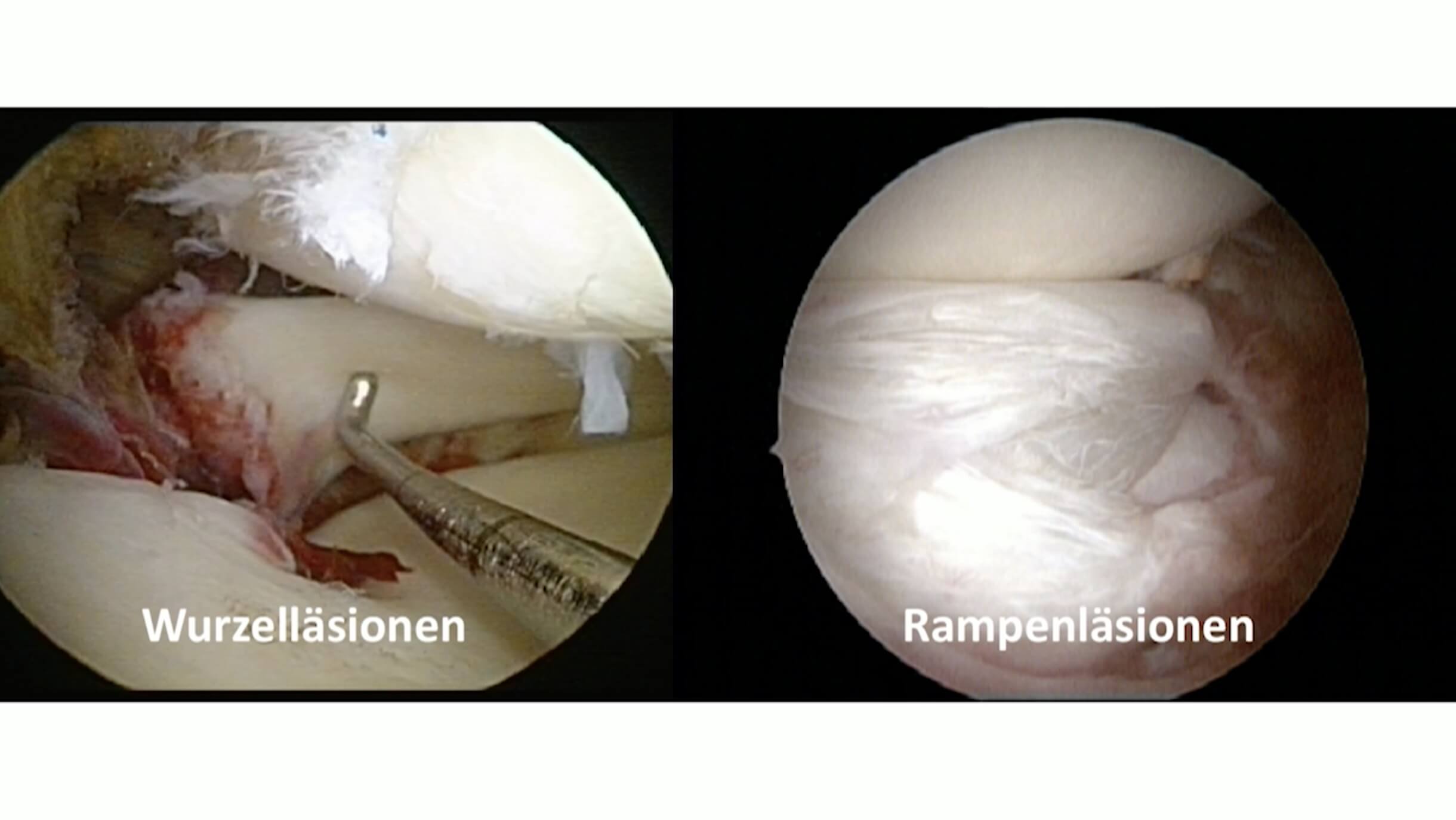 #254: Insights from the OR - Meniskuschirurgie – thumbnail 10 of 12