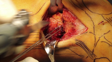 AGAnywhere Monthly - #002: Kniearthrose beim jüngeren Patienten – thumbnail 10 of 15