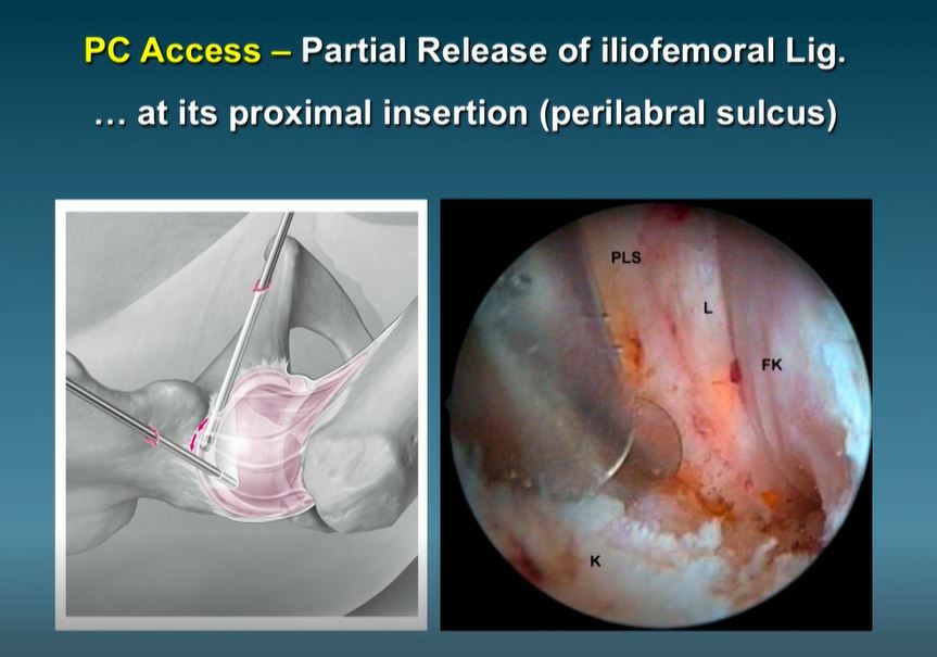 #192: Hip International - Basic Principles of Hip Arthroscopy – thumbnail 9 of 13