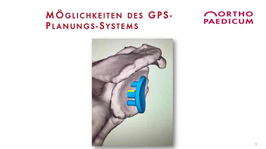 #175: Mein Plan, meine Umsetzung - Digitalisierte Schulterendoprothetik – thumbnail 10 of 17