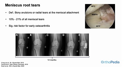 Meniscus Preservation in Degenerative Disorders – thumbnail 10 of 16