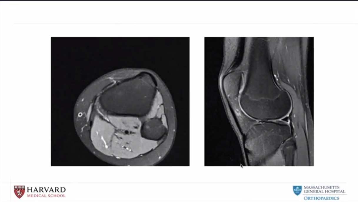 Across the Atlantic: American and European Insights on Patellar Instability – thumbnail 11 of 14