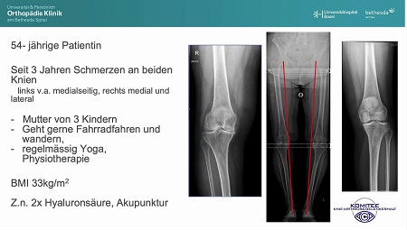 AGAnywhere Monthly - #002: Kniearthrose beim jüngeren Patienten – thumbnail 11 of 15