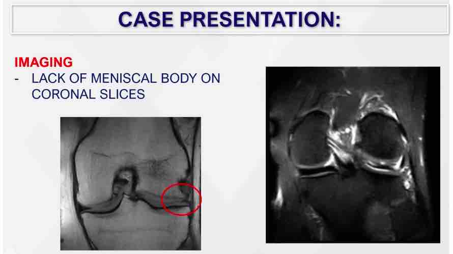 Winglet Originals #007: Complex Meniscal Pathologies – thumbnail 11 of 13