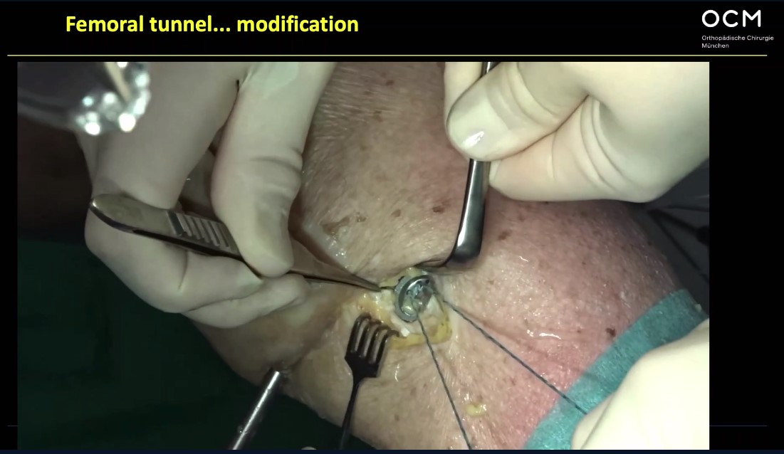 Winglet Originals #012: ACL Reconstruction – thumbnail 11 of 13