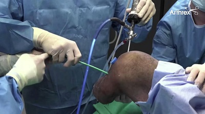 Meniscus Preservation in Degenerative Disorders – thumbnail 11 of 16