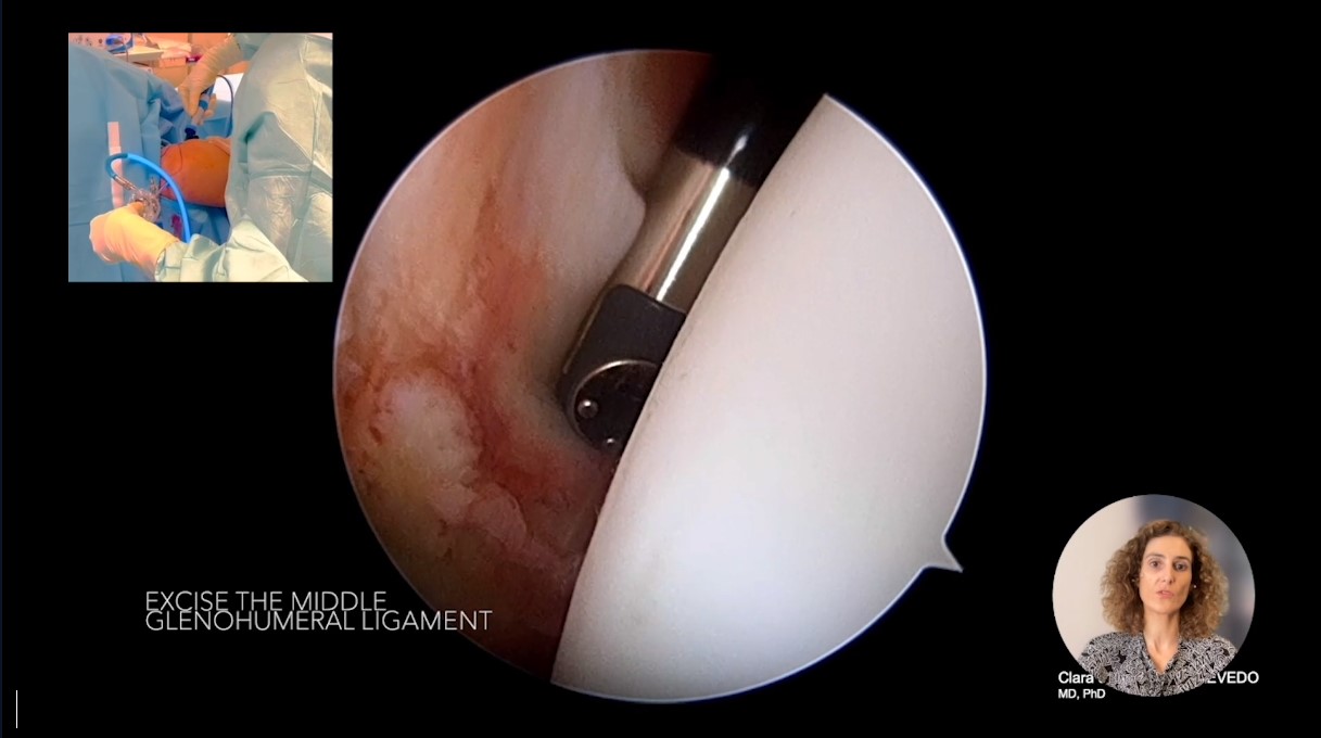 Across the Atlantic: American and European Insights on All Things Biceps Tendon – thumbnail 11 of 16