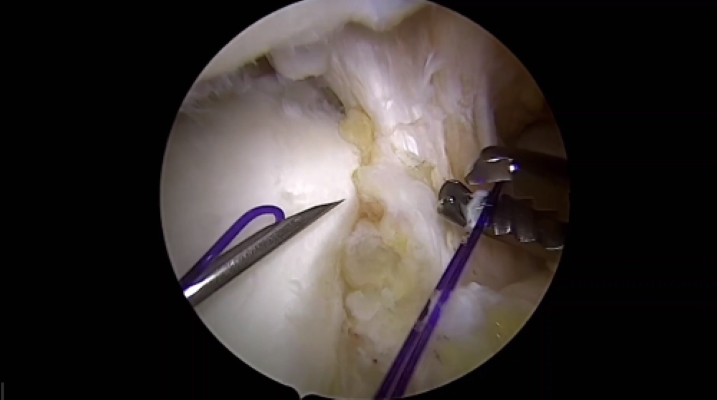 Winglet Originals #014: Basics in Knee Arthroscopy – thumbnail 11 of 19