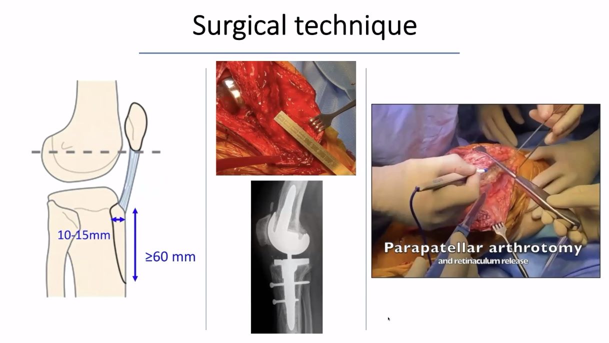 Winglet Originals #015: Revision Knee Arthroplasty – thumbnail 11 of 18