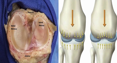 Meniscus Preservation in Degenerative Disorders – thumbnail 12 of 16