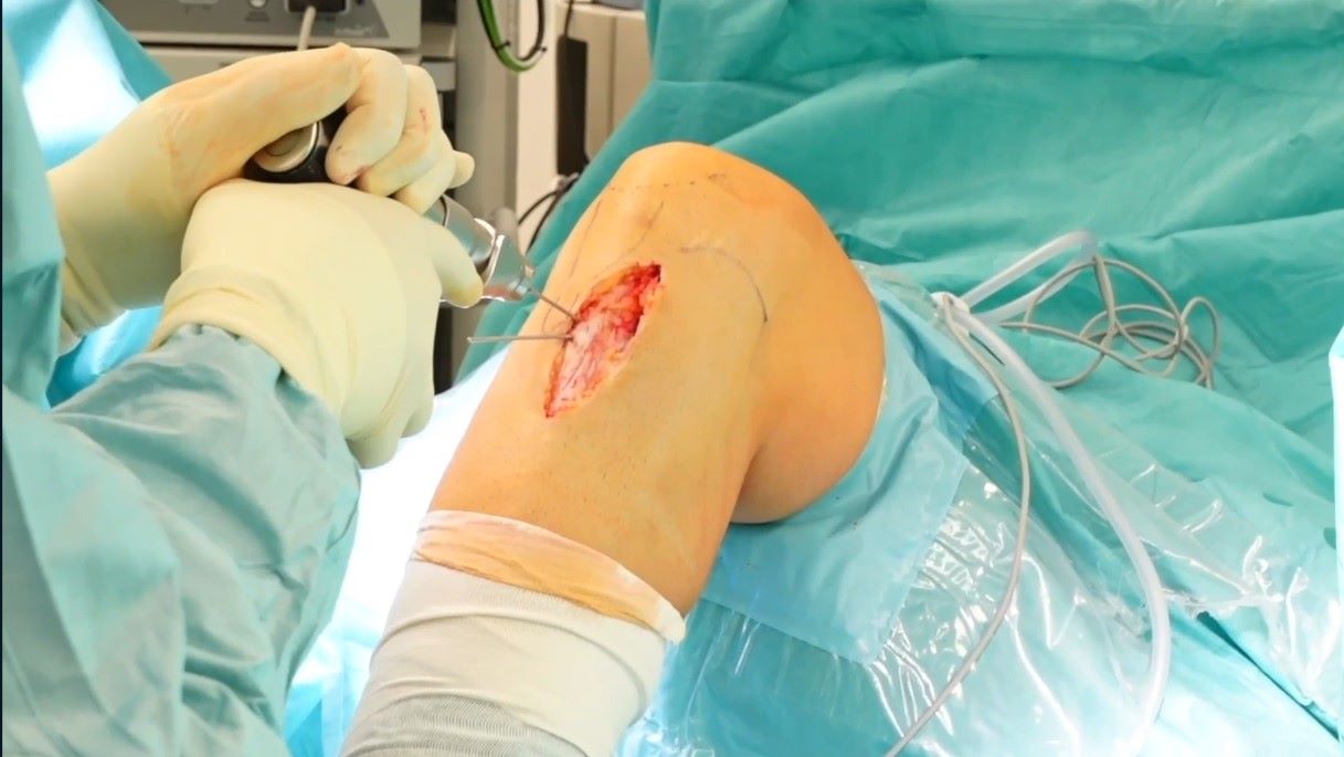 Orthopedic Film Festival 2024 – Lower Extremity & Sports – thumbnail 13 of 16