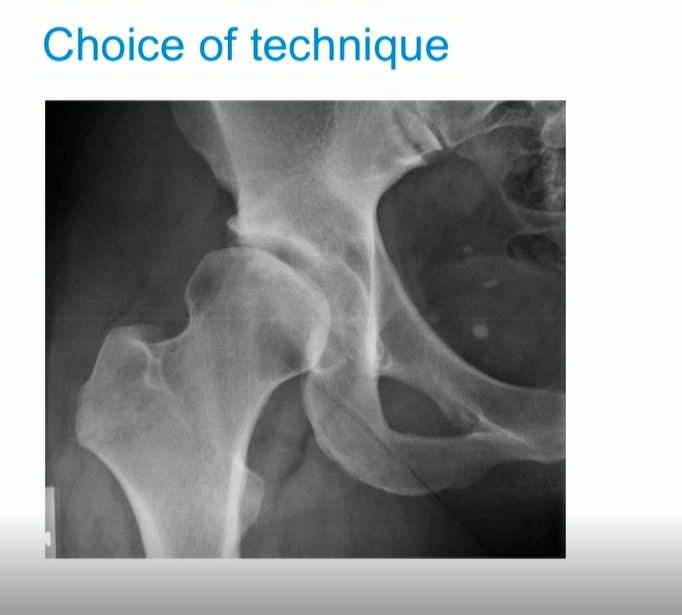 #192: Hip International - Basic Principles of Hip Arthroscopy – thumbnail 12 of 13