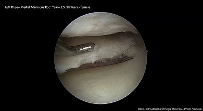 Meniscus Preservation in Degenerative Disorders – thumbnail 13 of 16