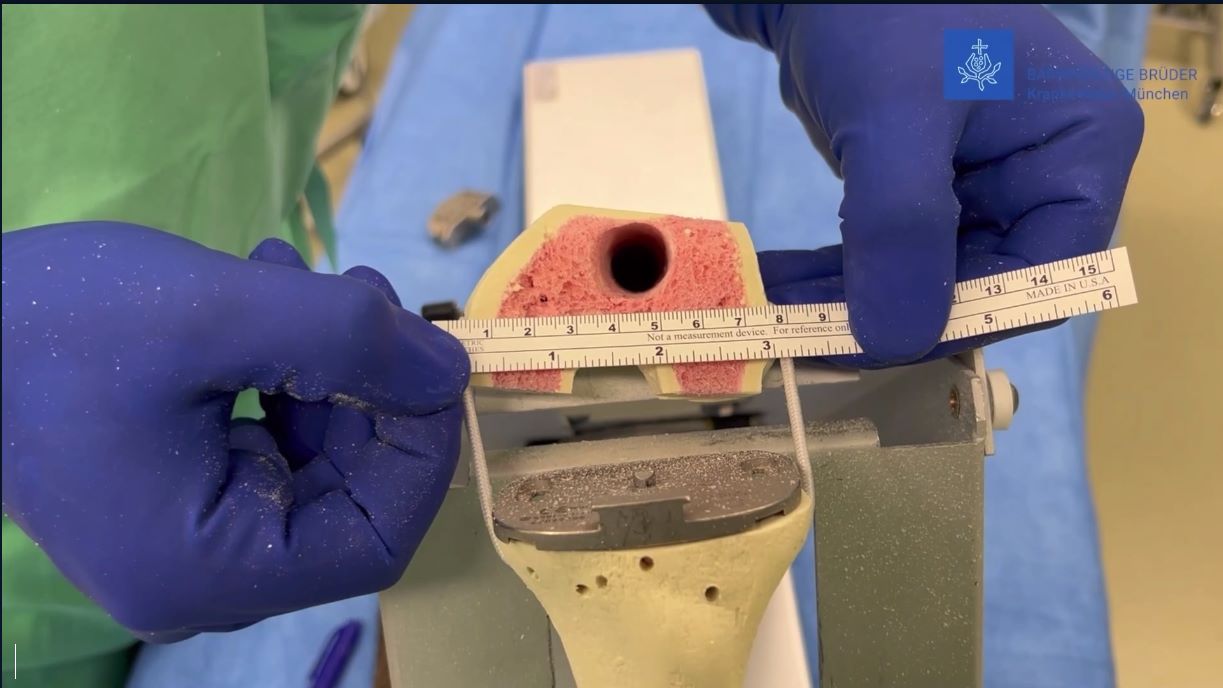 Winglet Originals #015: Revision Knee Arthroplasty – thumbnail 13 of 18