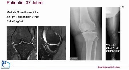AGAnywhere Monthly - #002: Kniearthrose beim jüngeren Patienten – thumbnail 14 of 15