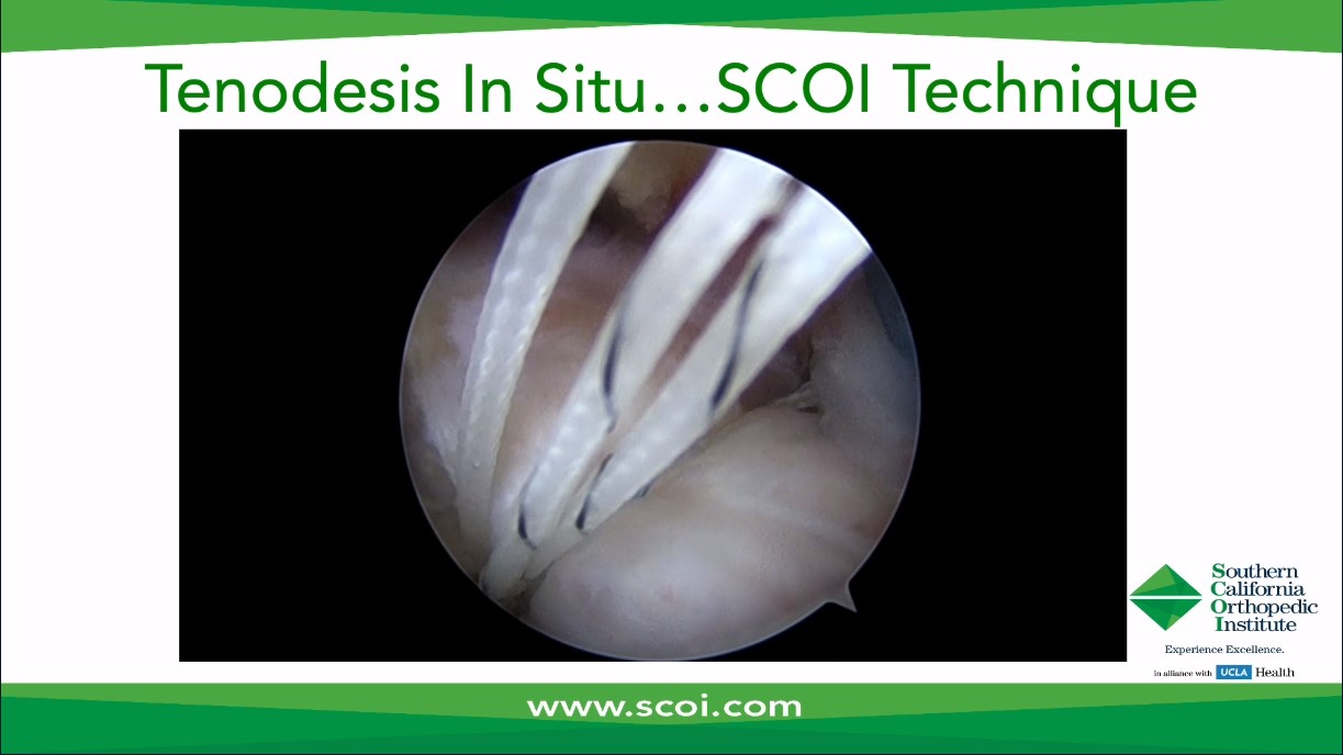 Across the Atlantic: American and European Insights on All Things Biceps Tendon – thumbnail 14 of 16