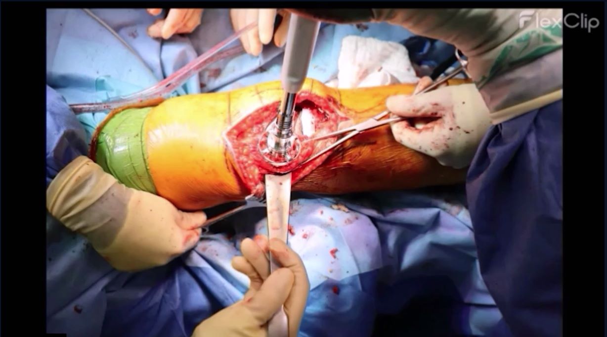 Winglet Originals #015: Revision Knee Arthroplasty – thumbnail 15 of 18