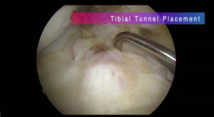 Winglet Originals #014: Basics in Knee Arthroscopy – thumbnail 15 of 19