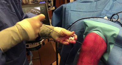 Meniscus Preservation in Degenerative Disorders – thumbnail 15 of 16