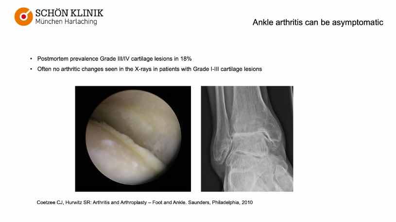 Winglet Originals #004: Malalignment and Early Osteoarthritis of the Ankle – thumbnail 1 of 11