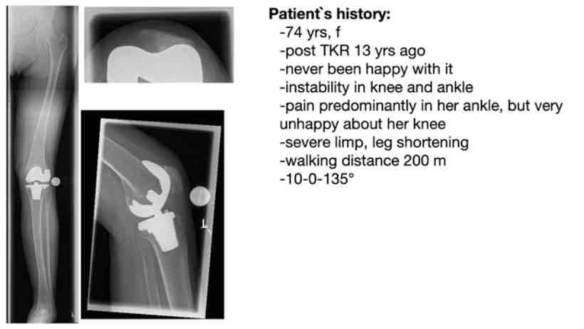 #214: Through the Eyes of the Surgeon - Challenging and Live Knee Revision – thumbnail 1 of 5